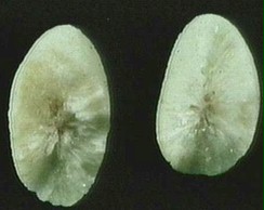 Cholesterol+gallstones