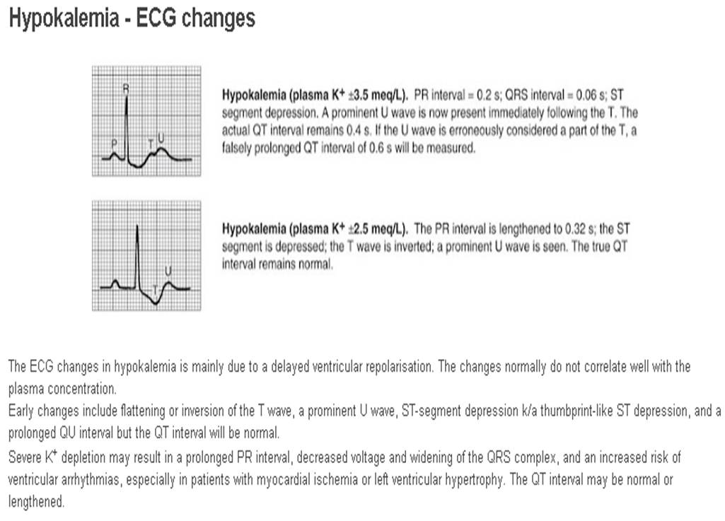 Гипокалиемия на экг картинки