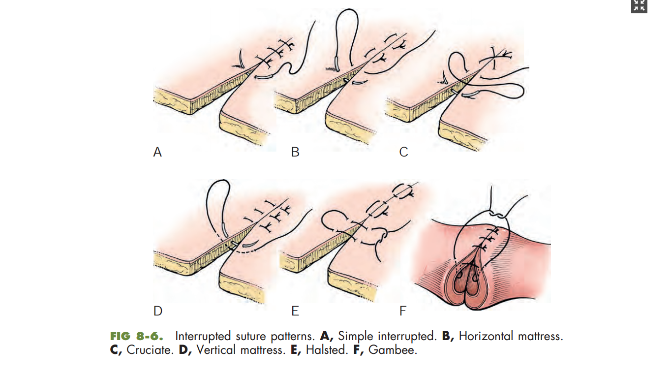 Interrupted suture patterns.